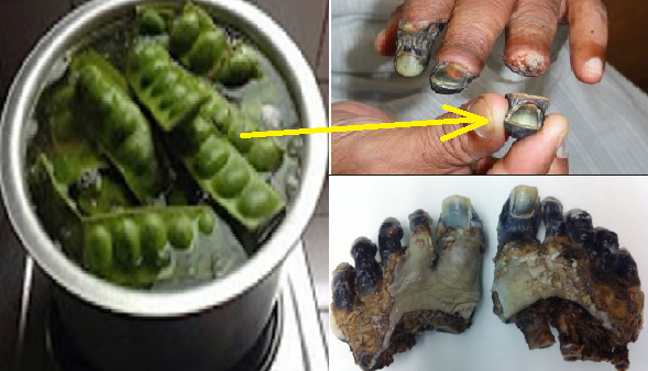 Manfaat kulit PETAI….. Simak yuk..